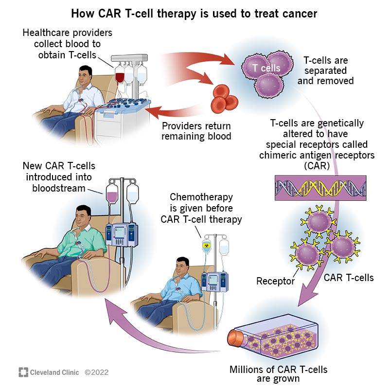 17726-car-t-cell-therapy.jpg